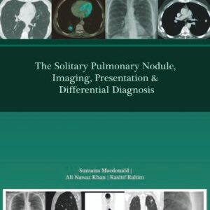 THE SOLITARY PULMONARY NODULE,IMAGING,PRESENTATION & DIFF DIAGNOSIS
